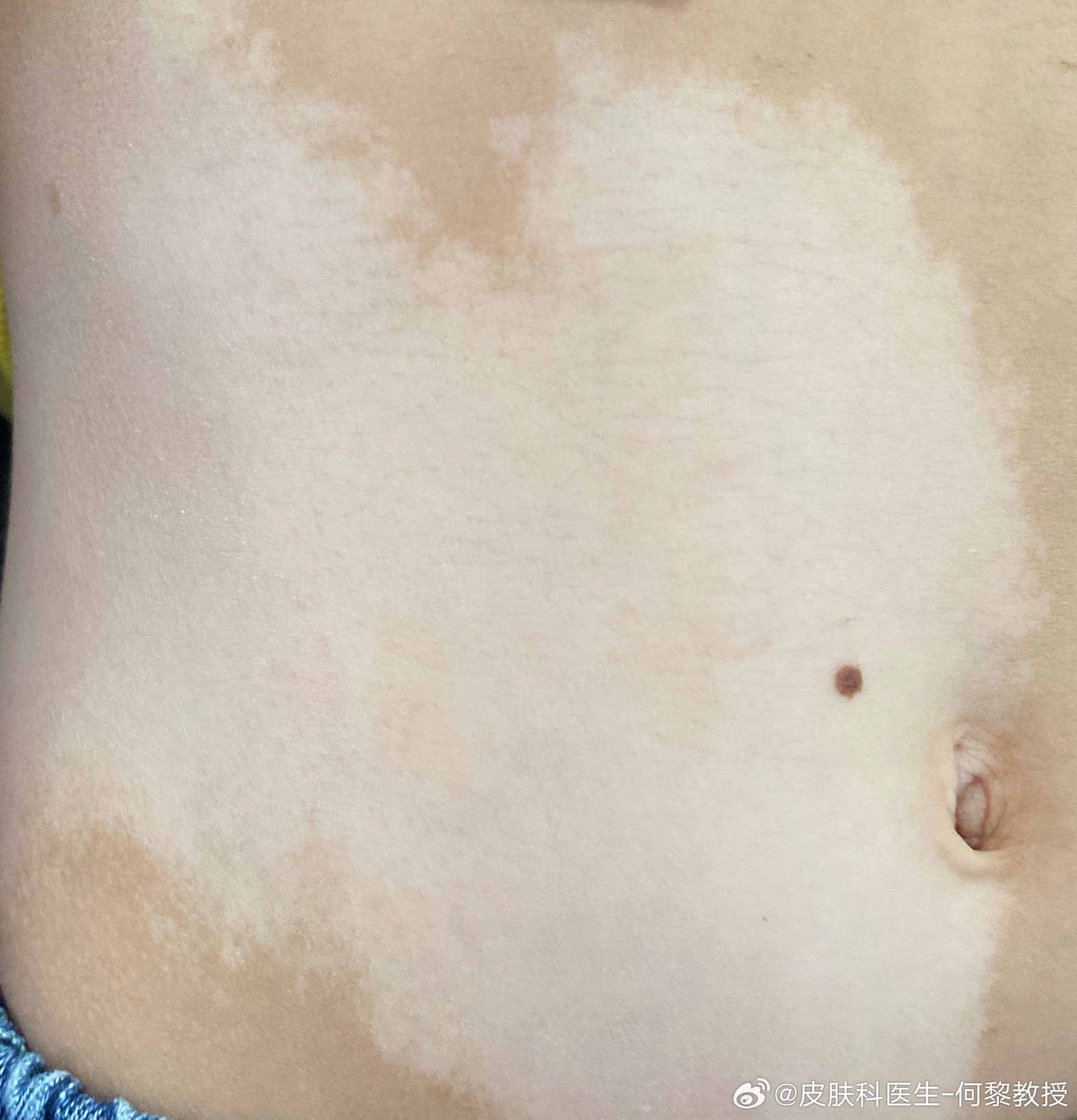 白斑治療新進展揭秘，小巷深處的秘密小店探索之路