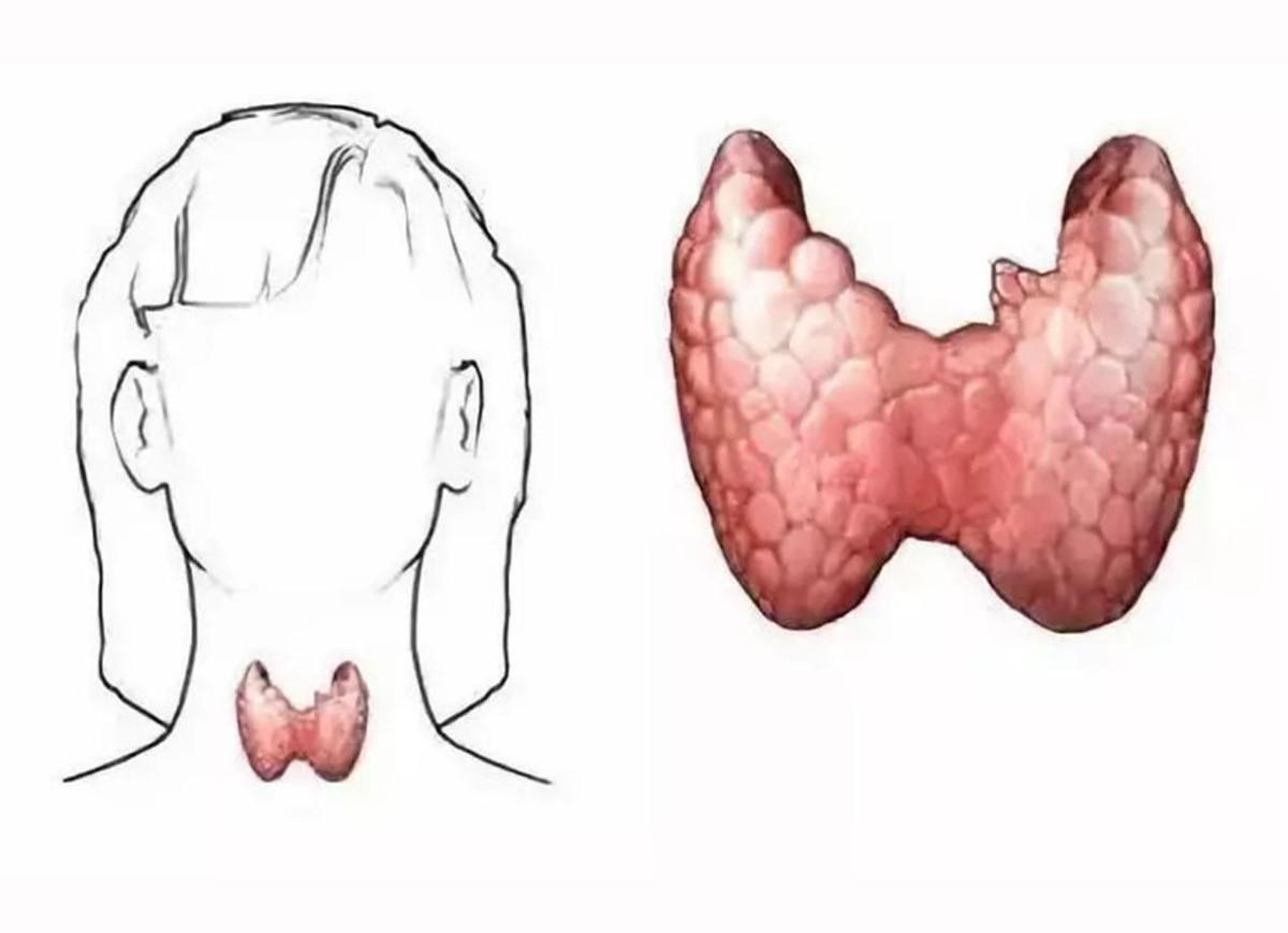 最新甲狀腺檢查步驟指南，詳細(xì)步驟解析