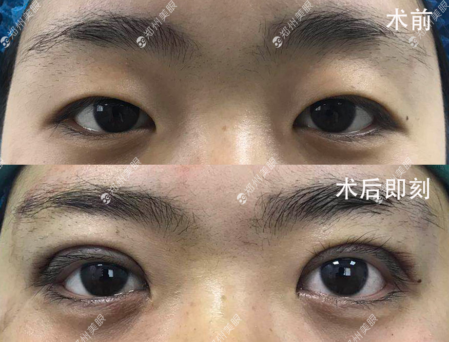 最新雙眼皮手術(shù)技巧，創(chuàng)新割雙眼皮方法解析